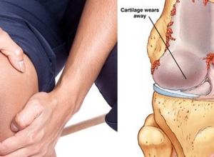 6 cách tự nhiên giúp giảm bùng phát viêm khớp khi trời lạnh